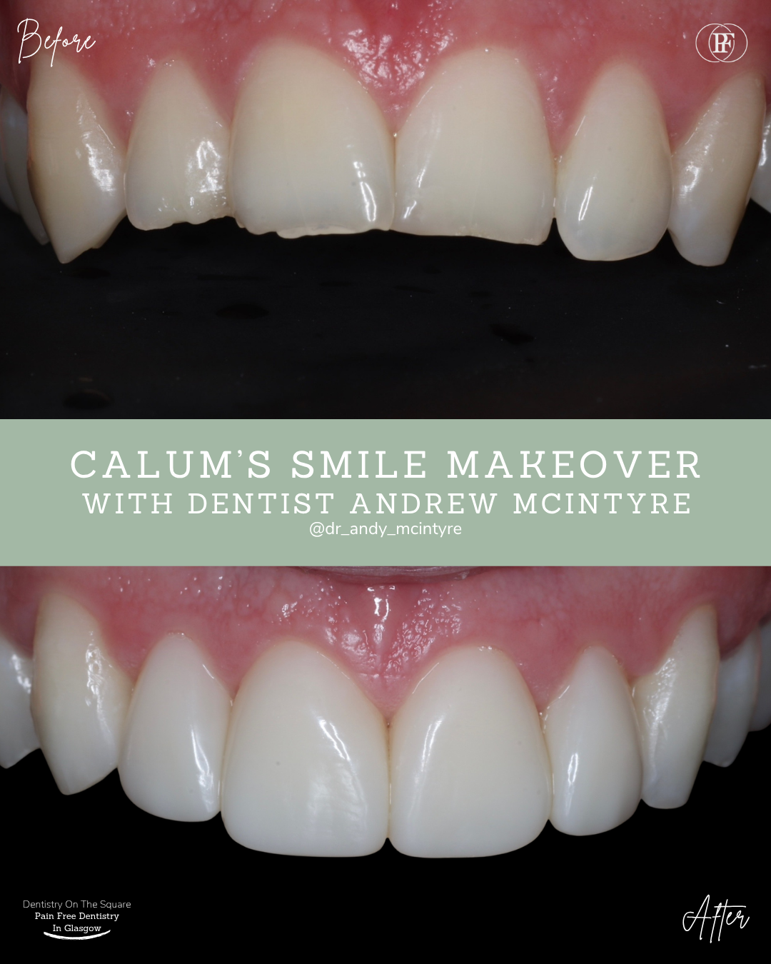 Dentistry On The Square, Pain Free Dentist Glasgow - Calum´s Smile Story