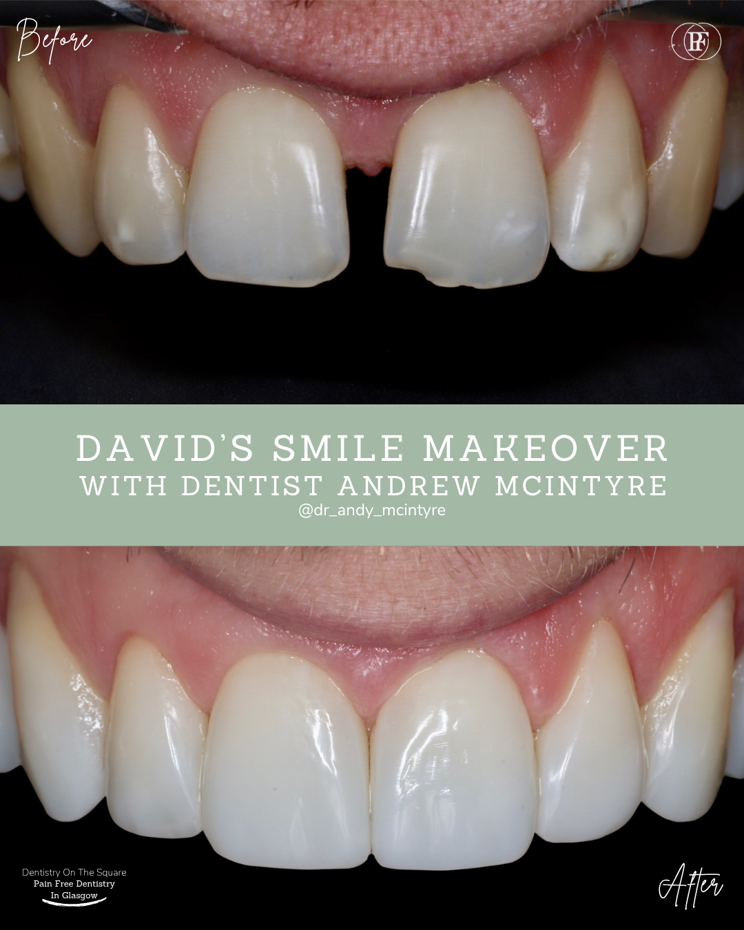 Dentistry On The Square, Pain Free Dentist Glasgow - David´s Smile Story