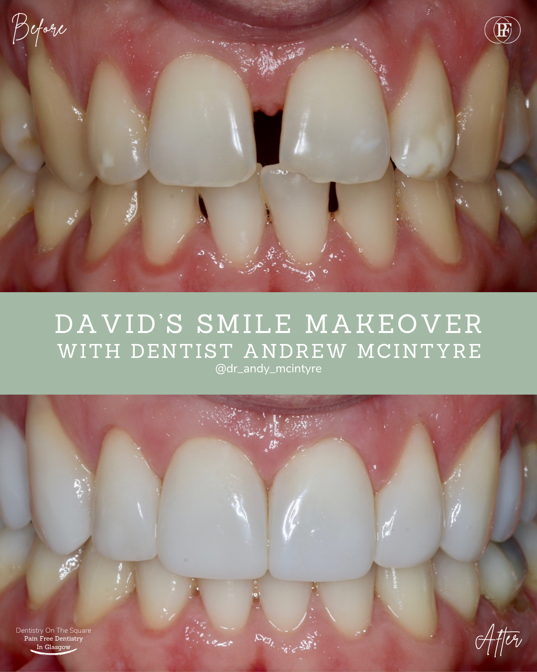 Dentistry On The Square, Pain Free Dentist Glasgow - David´s Smile Story