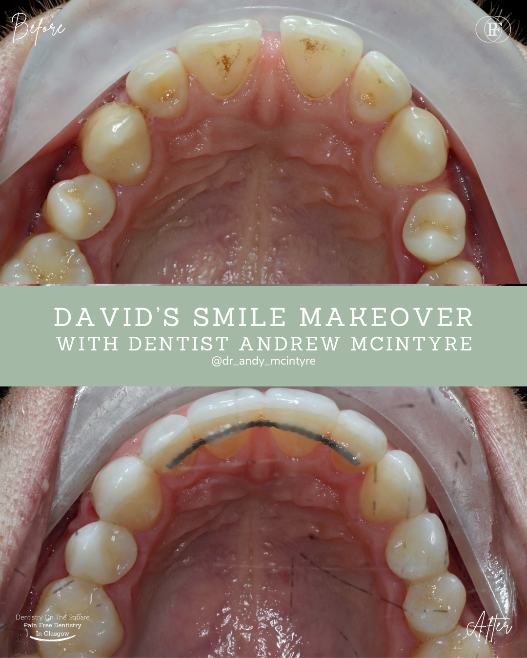 Dentistry On The Square, Pain Free Dentist Glasgow - David´s Smile Story