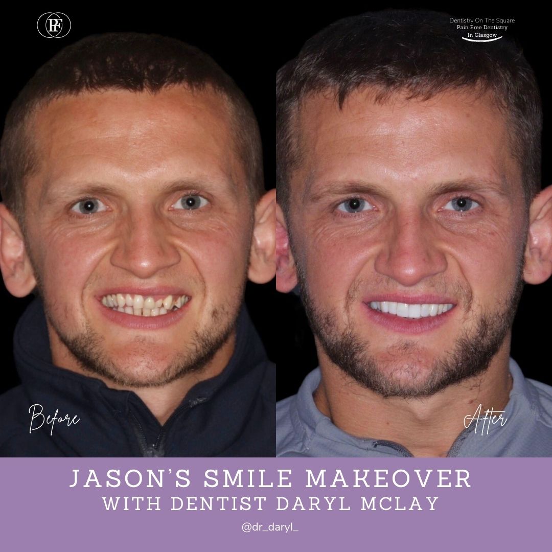 Dentistry On The Square, Pain Free Dentist Glasgow - Jason's Smile Story