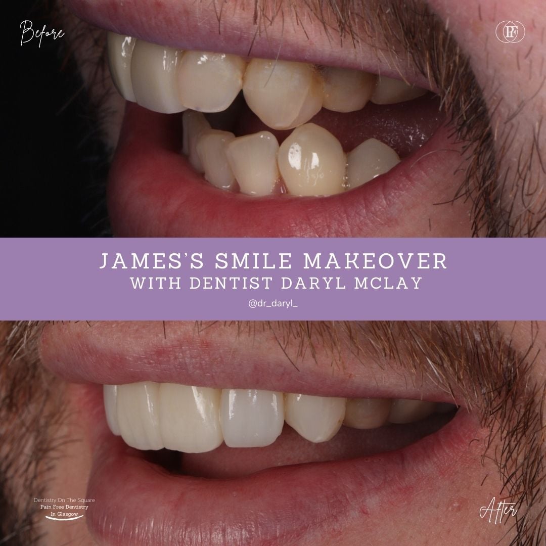 Dentistry On The Square, Pain Free Dentist Glasgow - James' Smile Story