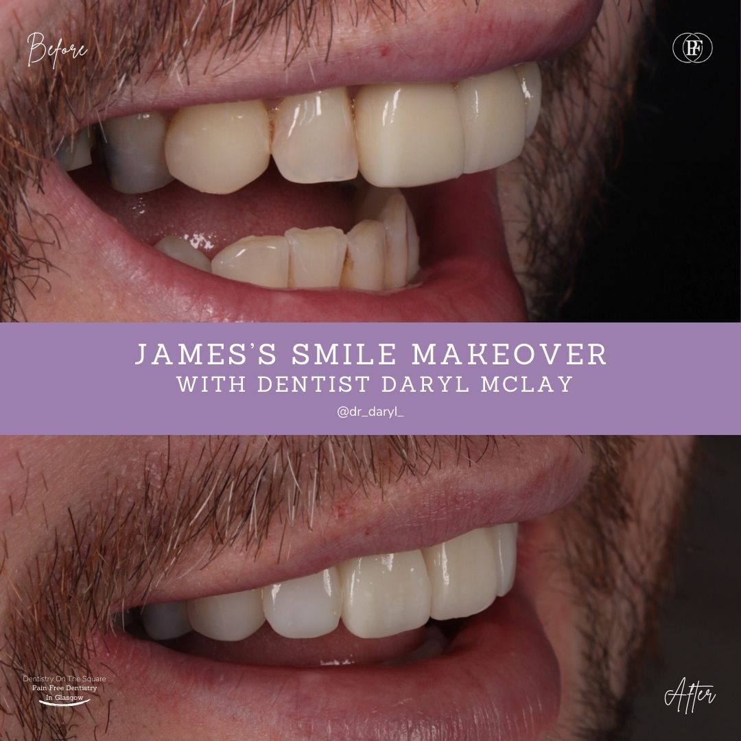 Dentistry On The Square, Pain Free Dentist Glasgow - James' Smile Story