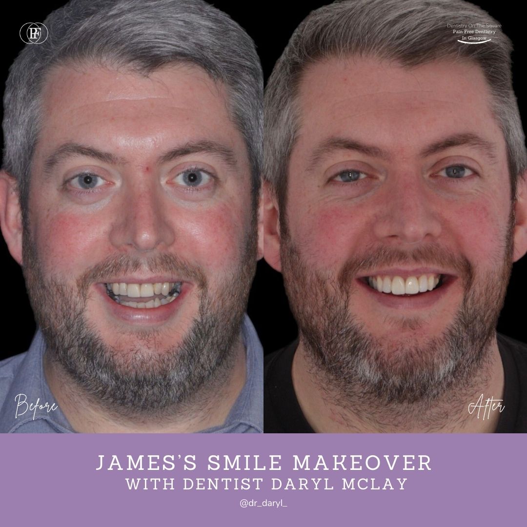 Dentistry On The Square, Pain Free Dentist Glasgow - James' Smile Story