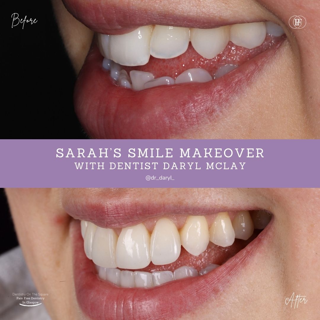 Dentistry On The Square, Pain Free Dentist Glasgow - Sarah's Smile Story