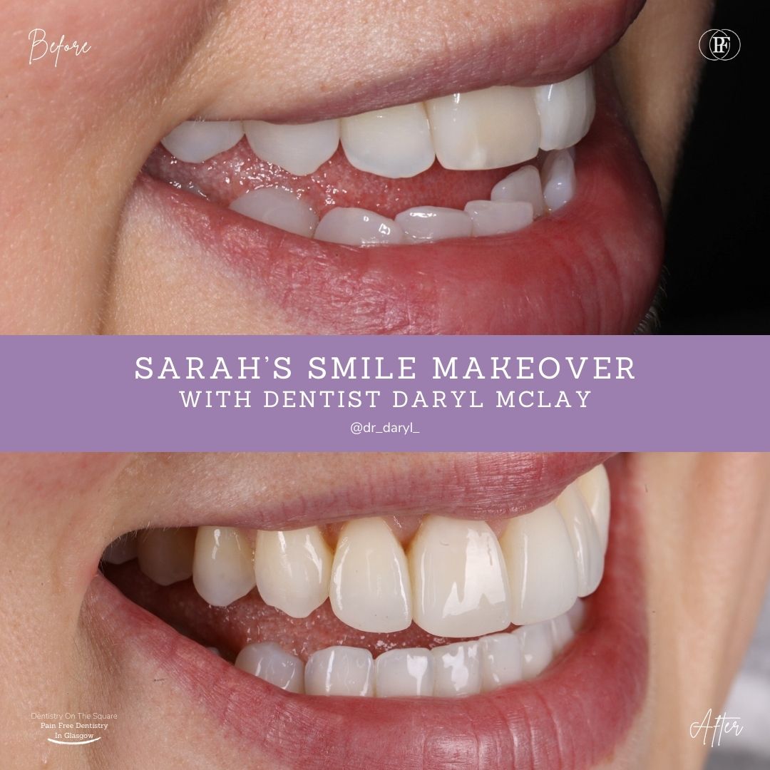 Dentistry On The Square, Pain Free Dentist Glasgow - Sarah's Smile Story
