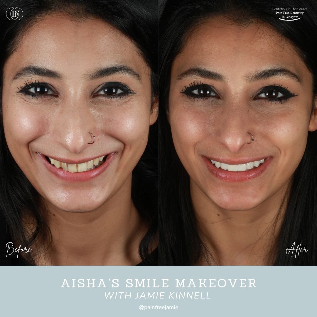 Dentistry On The Square, Pain Free Dentist Glasgow - Aisha's Smile Story Dentistry On The Square, Pain Free Dentist Glasgow - Aisha's Smile Story