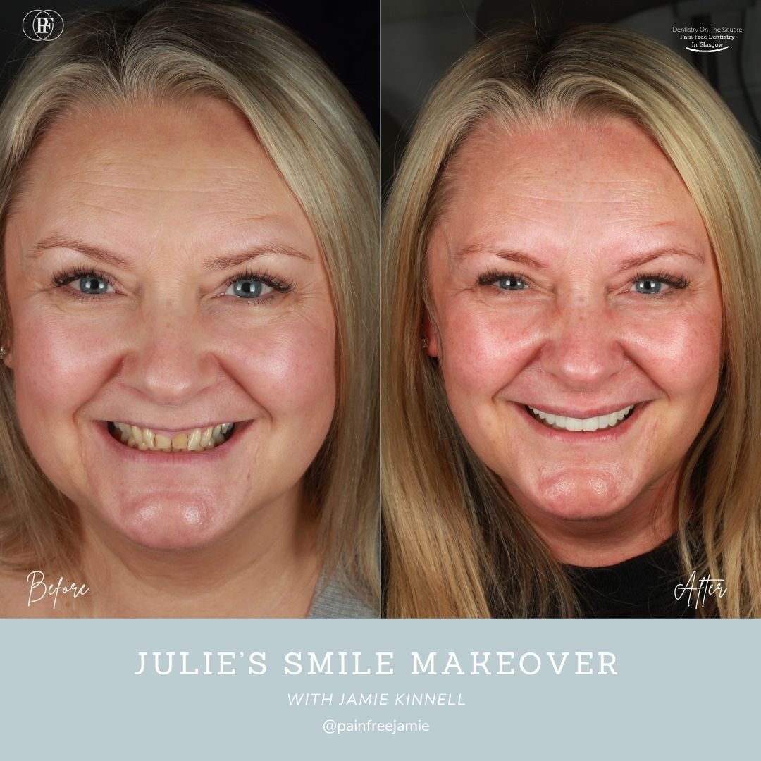 Dentistry On The Square, Pain Free Dentist Glasgow - Julie’s Smile Story