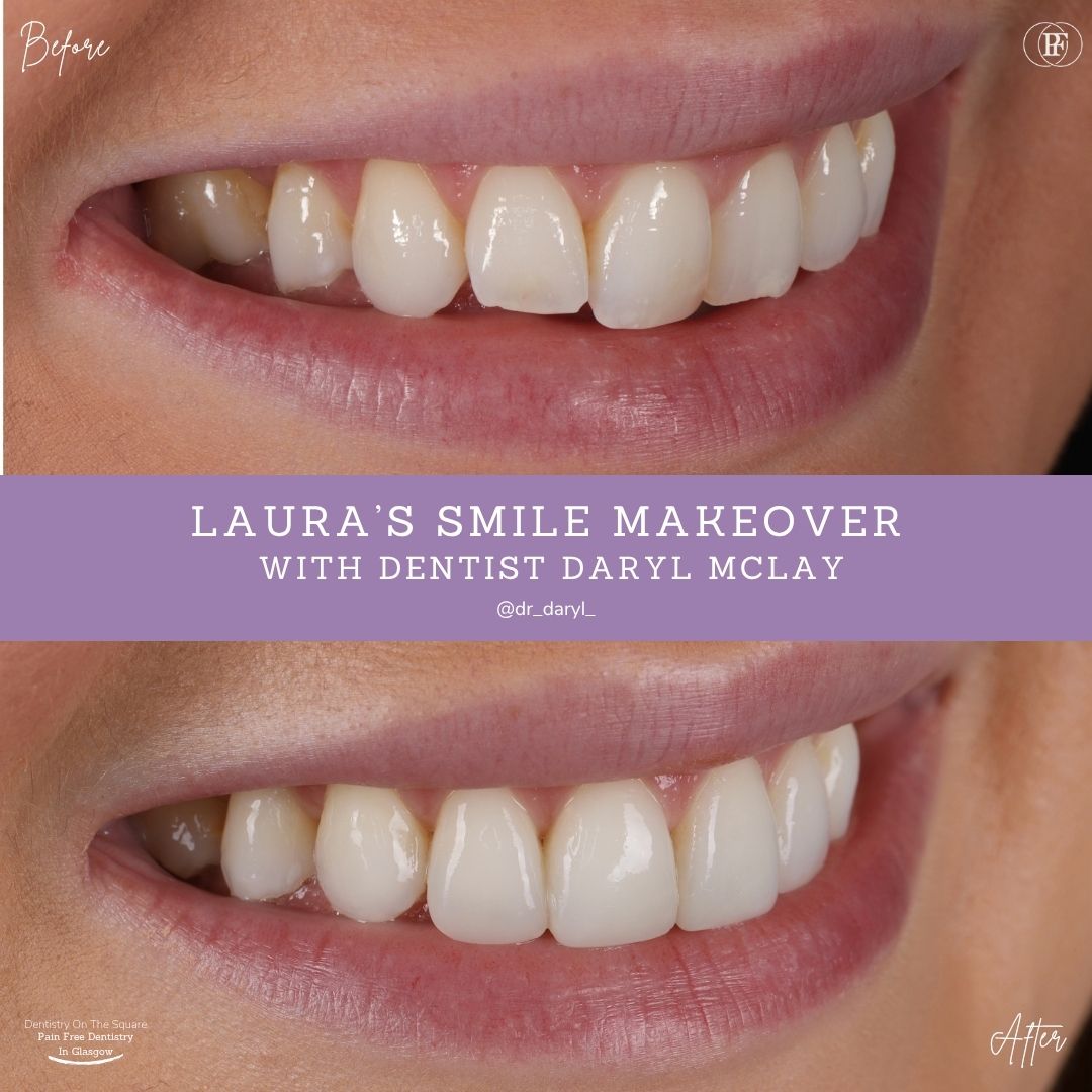 Dentistry On The Square, Pain Free Dentist Glasgow - Laura’s Smile Story