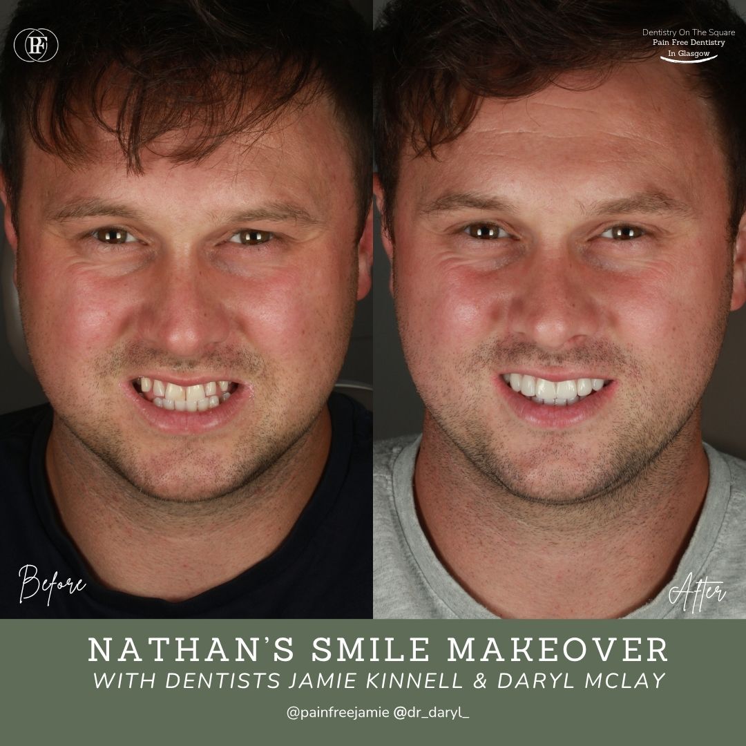 Dentistry On The Square, Pain Free Dentist Glasgow - Nathan's Smile Makeover