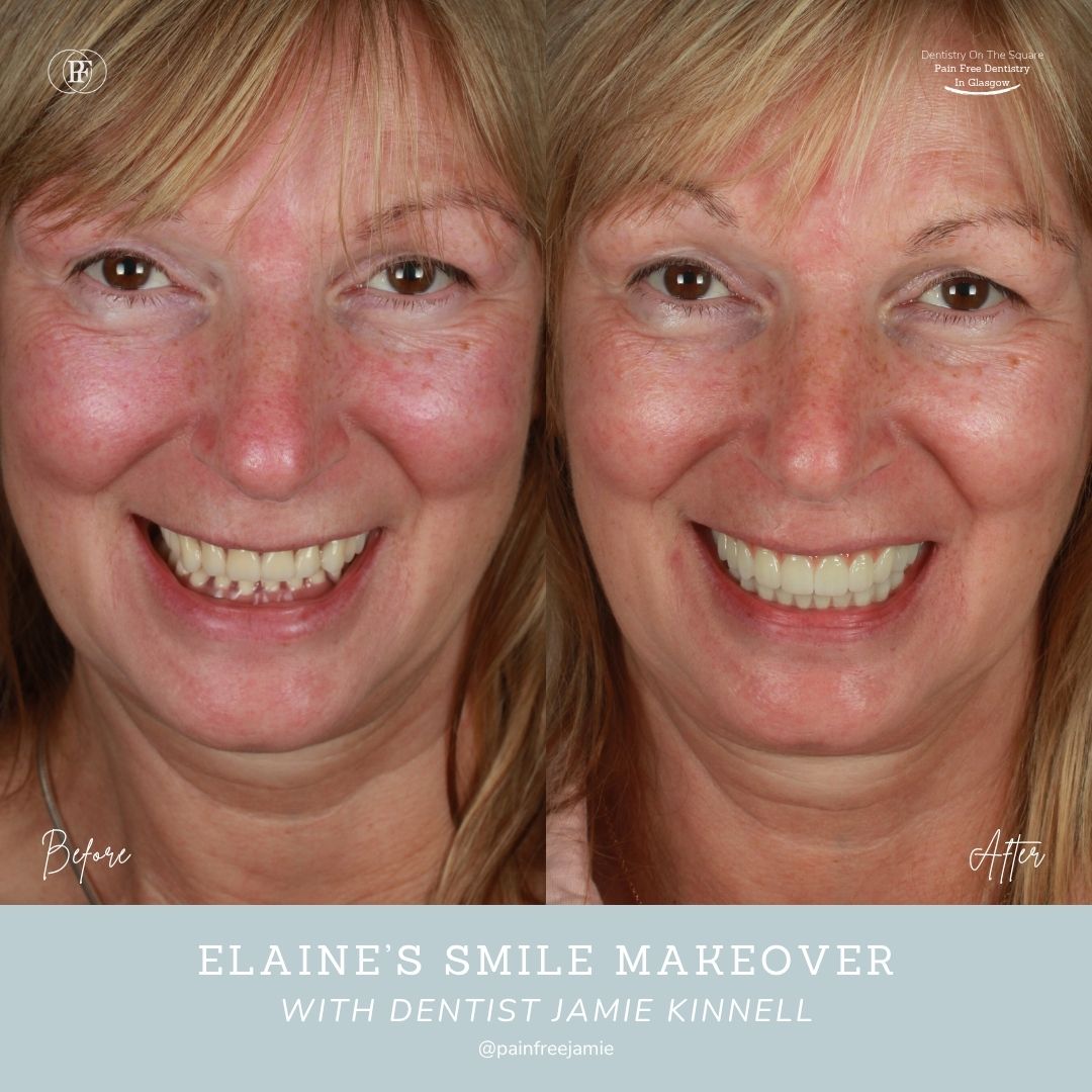 Dentistry On The Square, Pain Free Dentist Glasgow - Elaine’s Smile Story Dentistry On The Square, Pain Free Dentist Glasgow - Elaine’s Smile Story