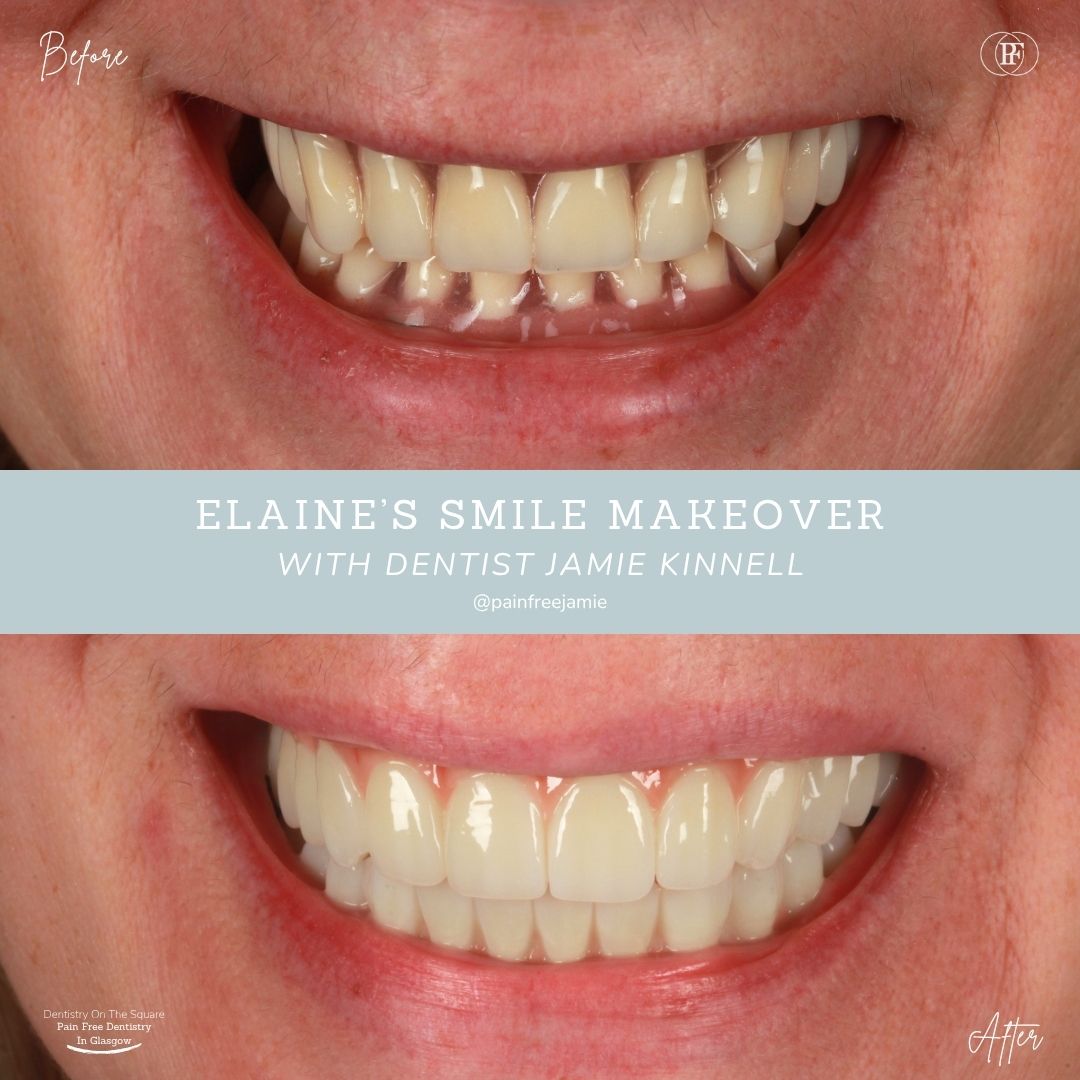 Dentistry On The Square, Pain Free Dentist Glasgow - Elaine’s Smile Story Ross's Smile Story with Andy
