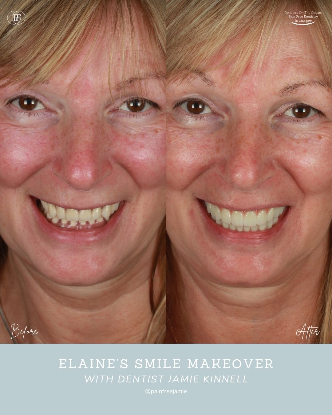 Elaine's Smile Story