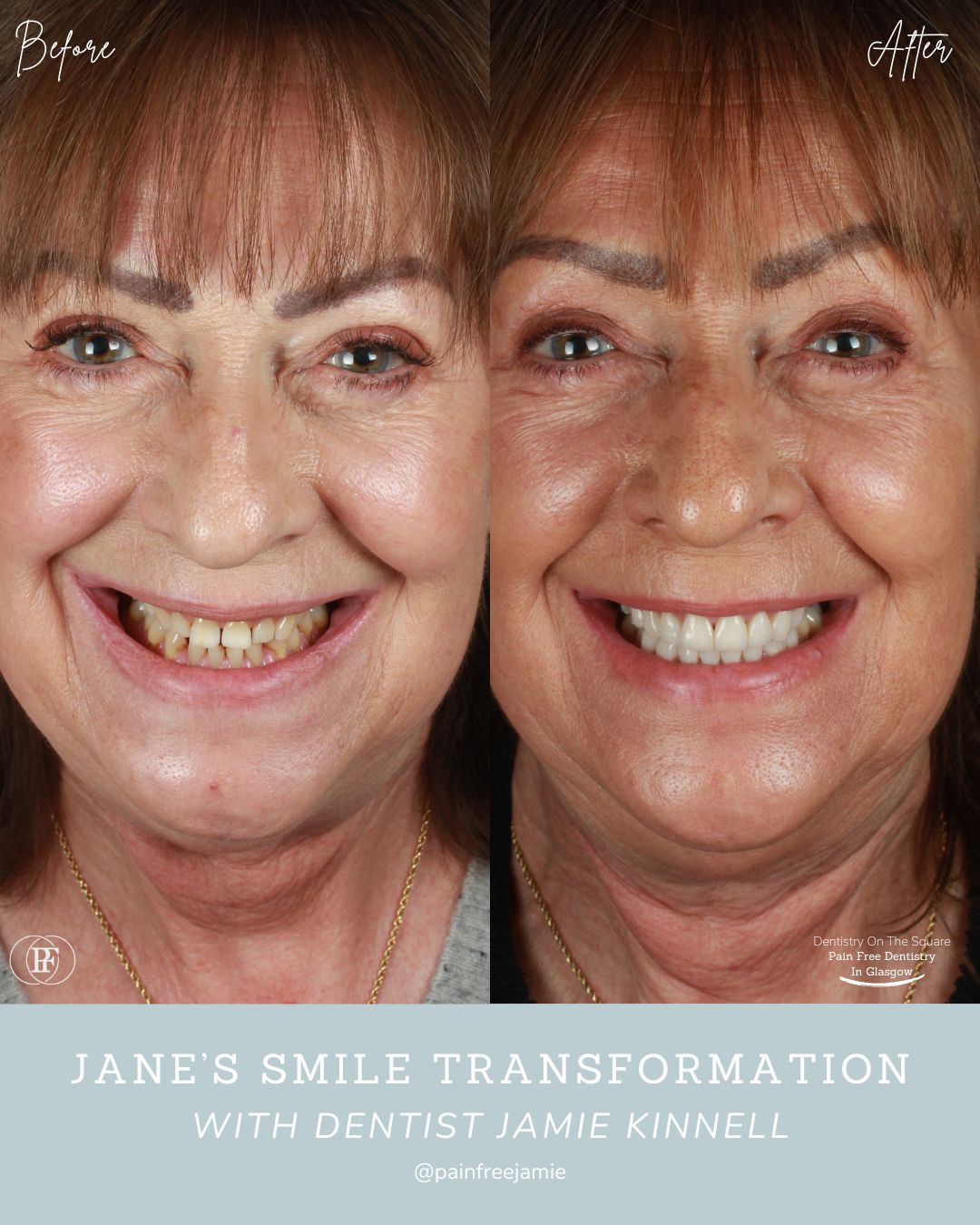 Jane's Smile Story
