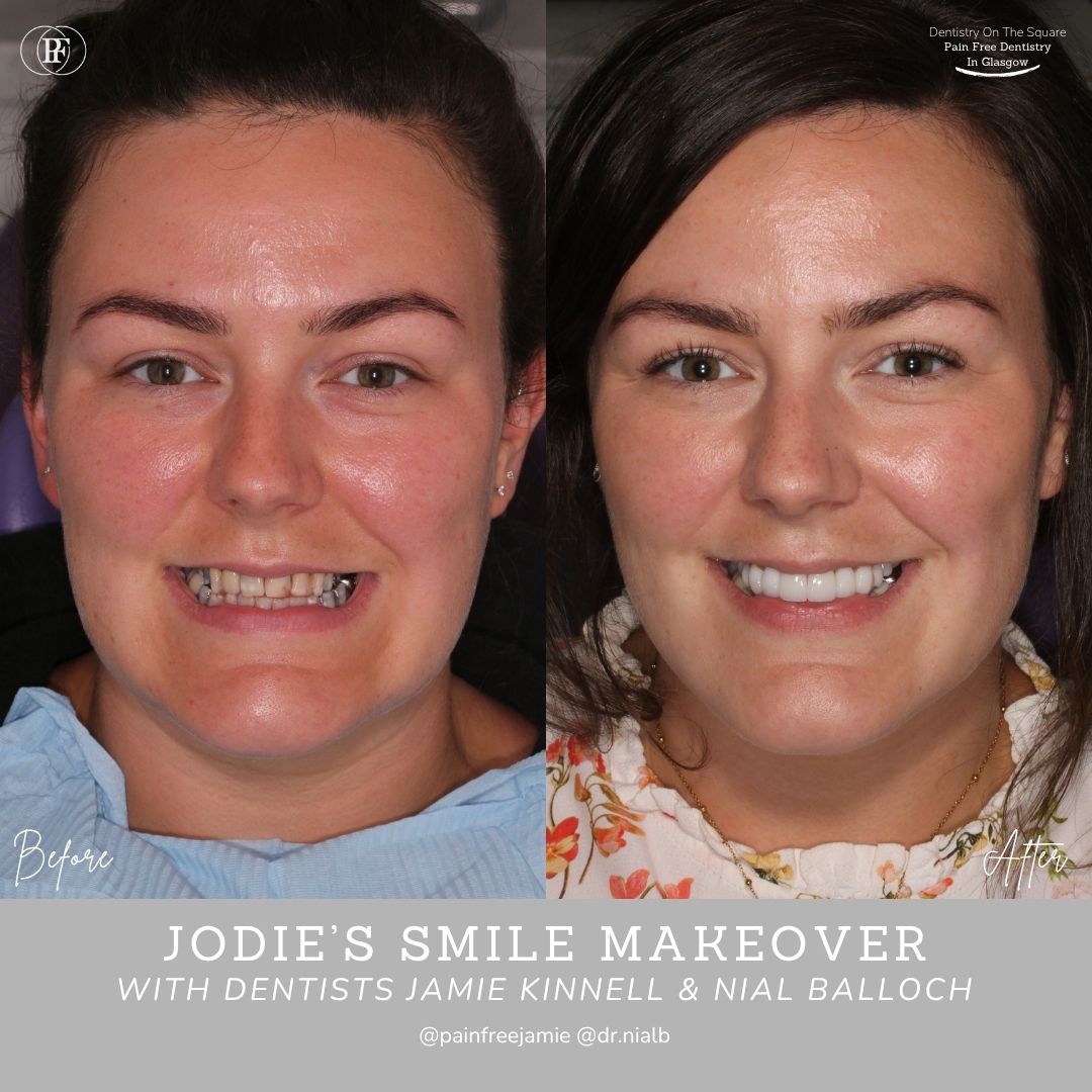 Dentistry On The Square, Pain Free Dentist Glasgow - Jodie's Smile Story