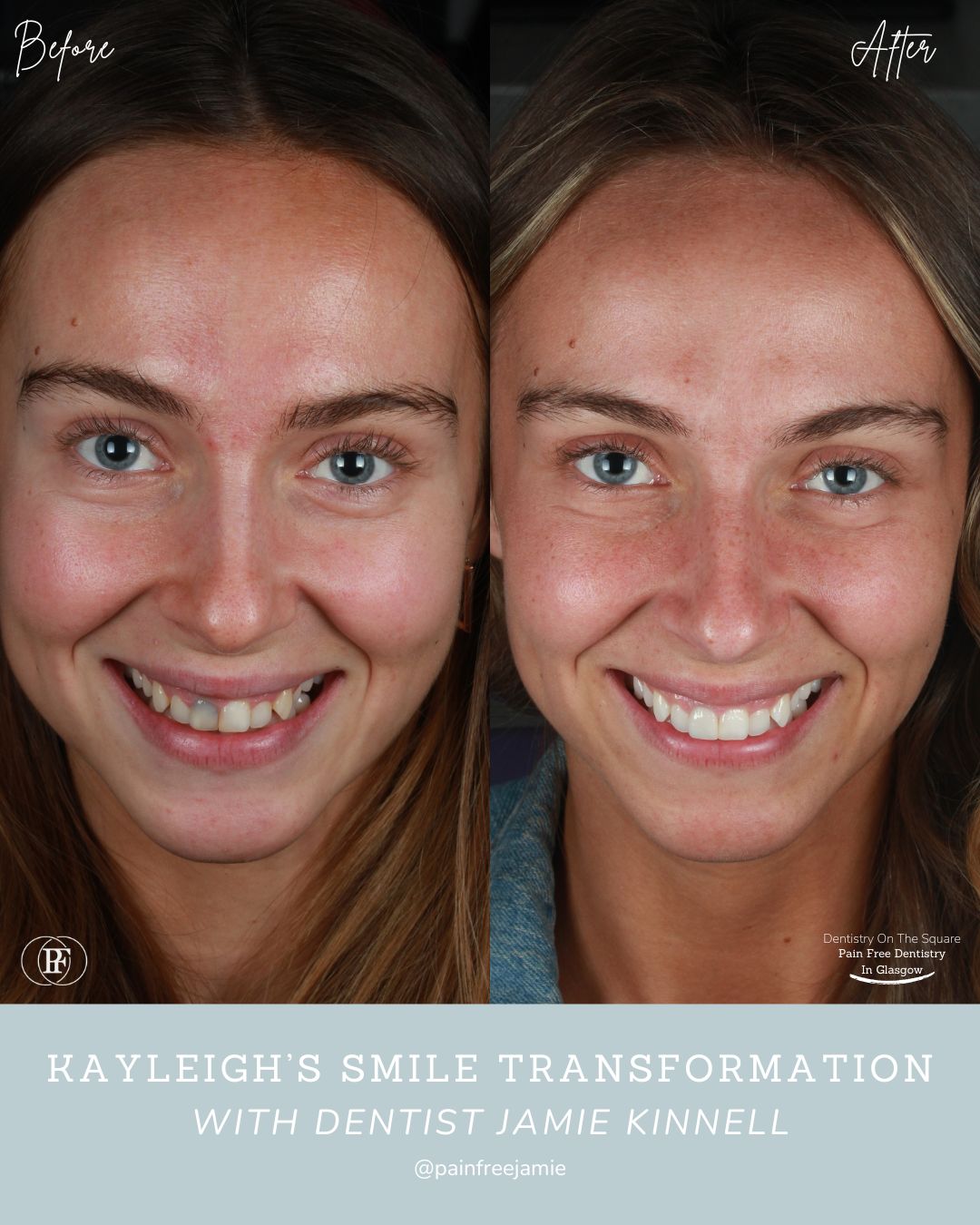 Kayleigh's Smile Story