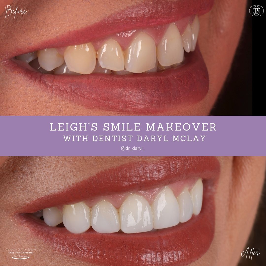Dentistry On The Square, Pain Free Dentist Glasgow - Leigh’s Smile Story