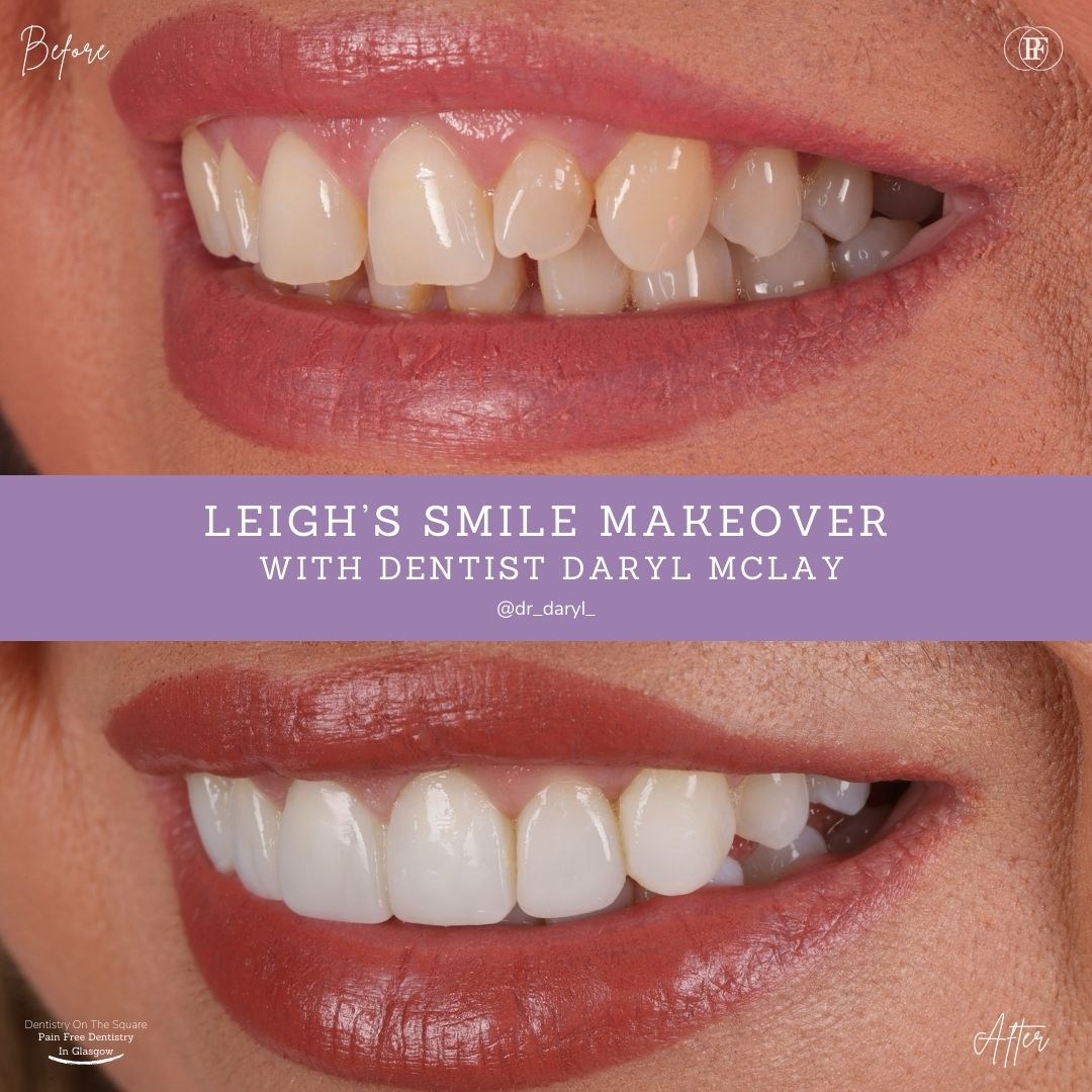 Dentistry On The Square, Pain Free Dentist Glasgow - Leigh’s Smile Story