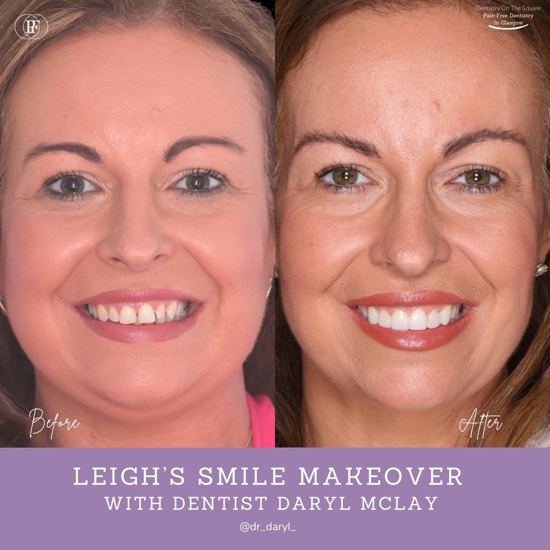 Dentistry On The Square, Pain Free Dentist Glasgow - Leigh’s Smile Story