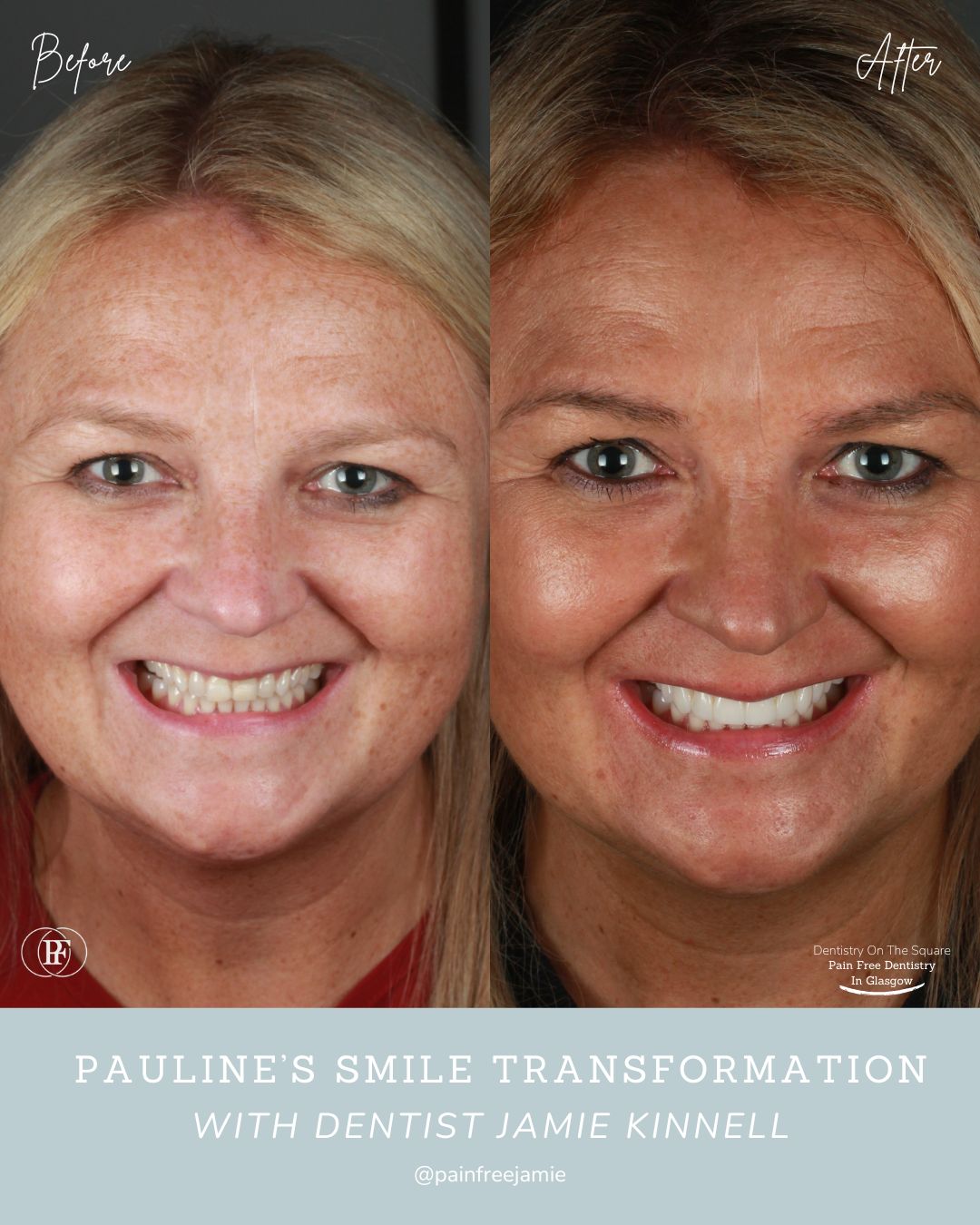 Pauline's Smile Story