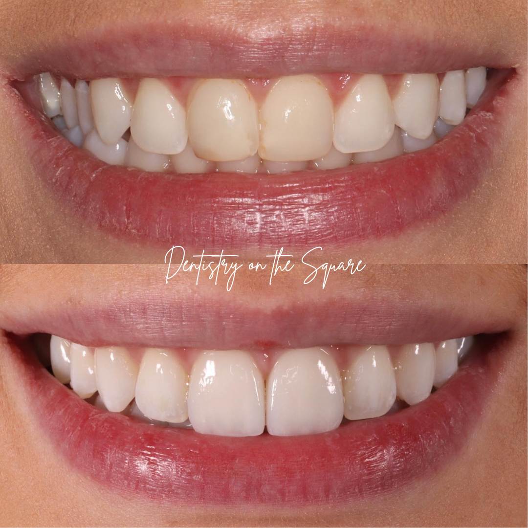 Dentistry On The Square, Pain Free Dentist Glasgow - Request A Complimentary Consultation Before and after treatment at Dentistry On The Square in Glasgow