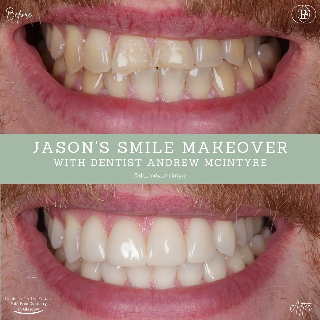 Dentistry On The Square, Pain Free Dentist Glasgow - Jason's Smile Story Jason's Smile Story with Andy