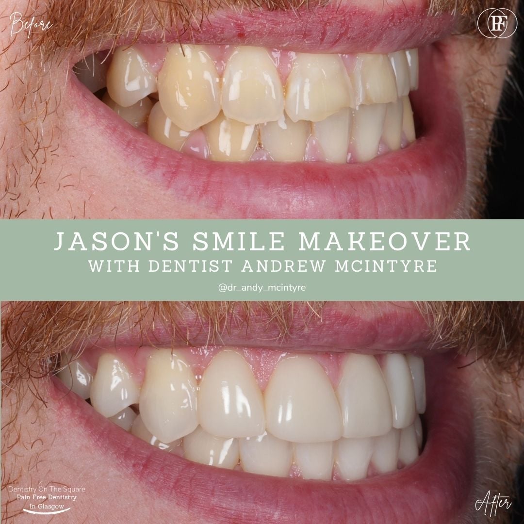 Dentistry On The Square, Pain Free Dentist Glasgow - Jason's Smile Story Dentistry On The Square, Pain Free Dentist Glasgow - Jason's Smile Story