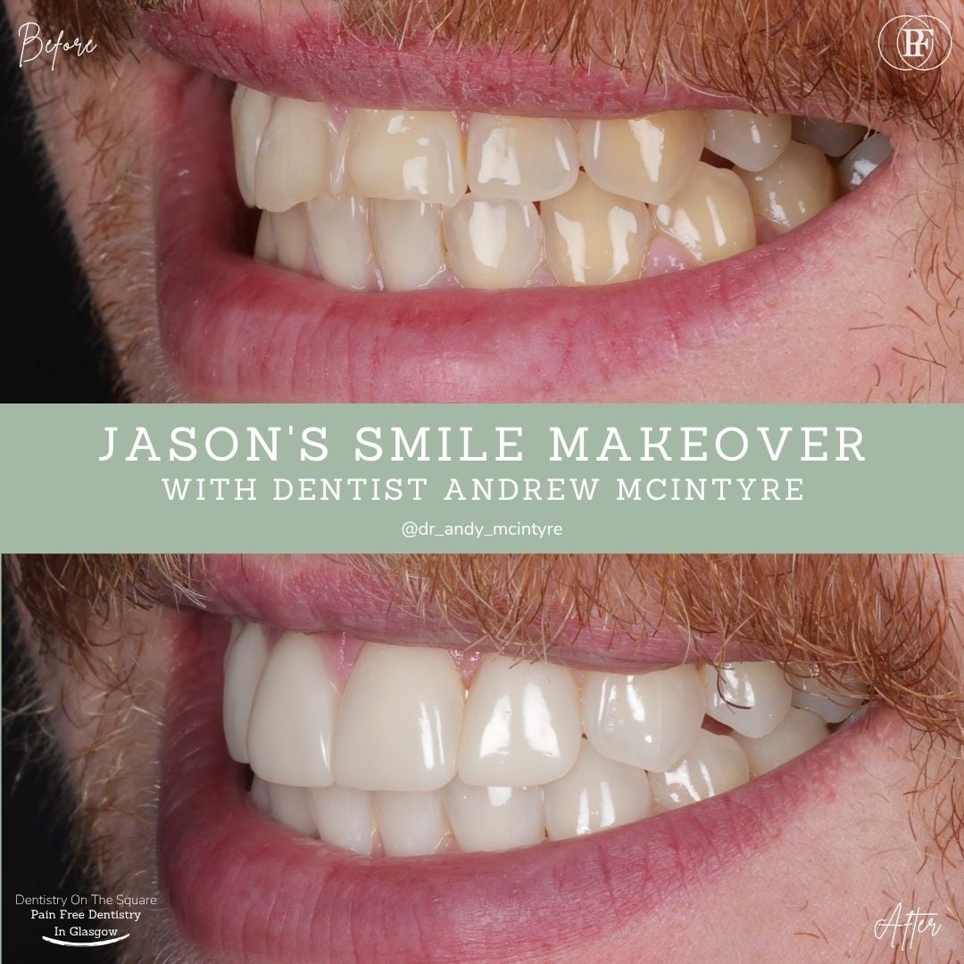 Dentistry On The Square, Pain Free Dentist Glasgow - Jason's Smile Story Dentistry On The Square, Pain Free Dentist Glasgow - Jason's Smile Story