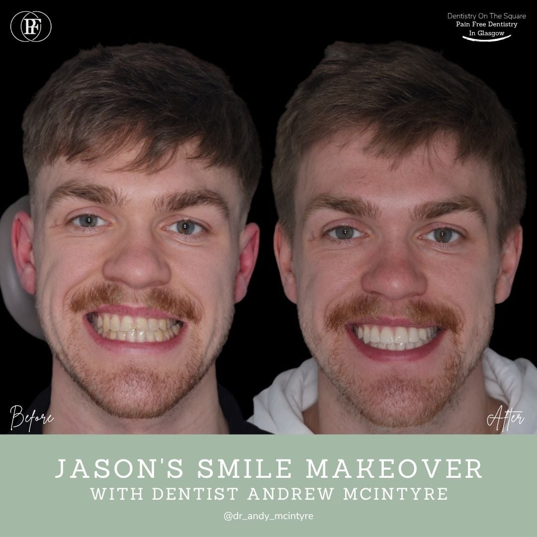 Dentistry On The Square, Pain Free Dentist Glasgow - Jason's Smile Story Ross's smile story