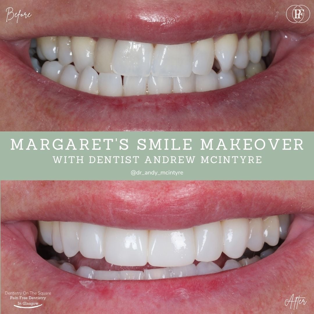 Dentistry On The Square, Pain Free Dentist Glasgow - Margaret's Smile Story Dentistry On The Square, Pain Free Dentist Glasgow - Margaret's Smile Story