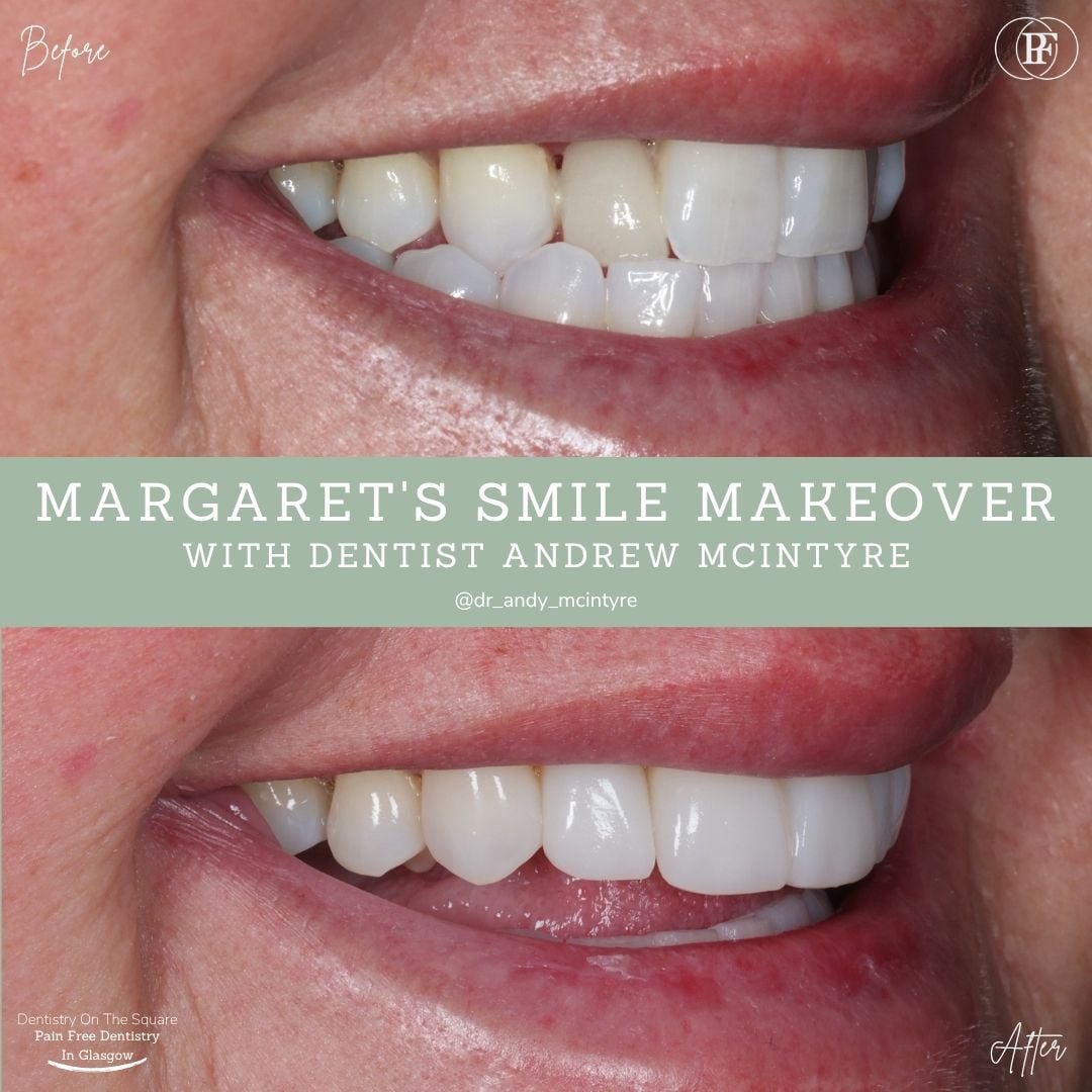 Dentistry On The Square, Pain Free Dentist Glasgow - Margaret's Smile Story Dentistry On The Square, Pain Free Dentist Glasgow - Margaret's Smile Story