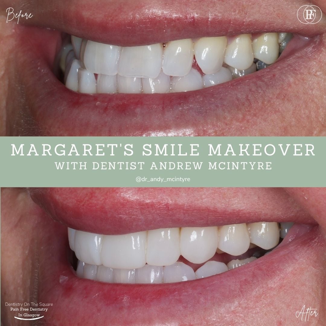 Dentistry On The Square, Pain Free Dentist Glasgow - Margaret's Smile Story Dentistry On The Square, Pain Free Dentist Glasgow - Margaret's Smile Story
