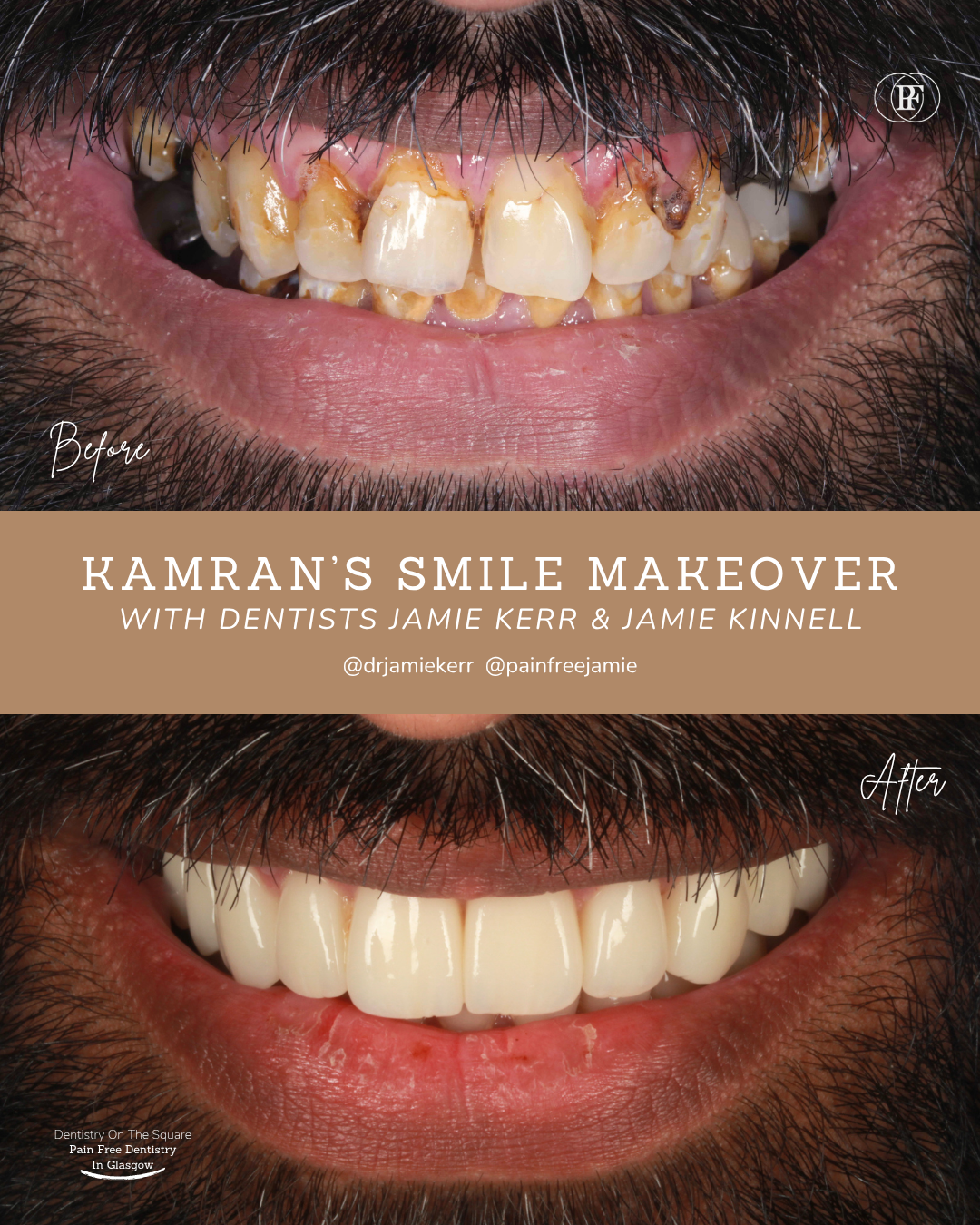 Dentistry On The Square, Pain Free Dentist Glasgow - Kamran's Smile Story Kamran S Smile Story With Jamie Kerr And Jamie Kinnell