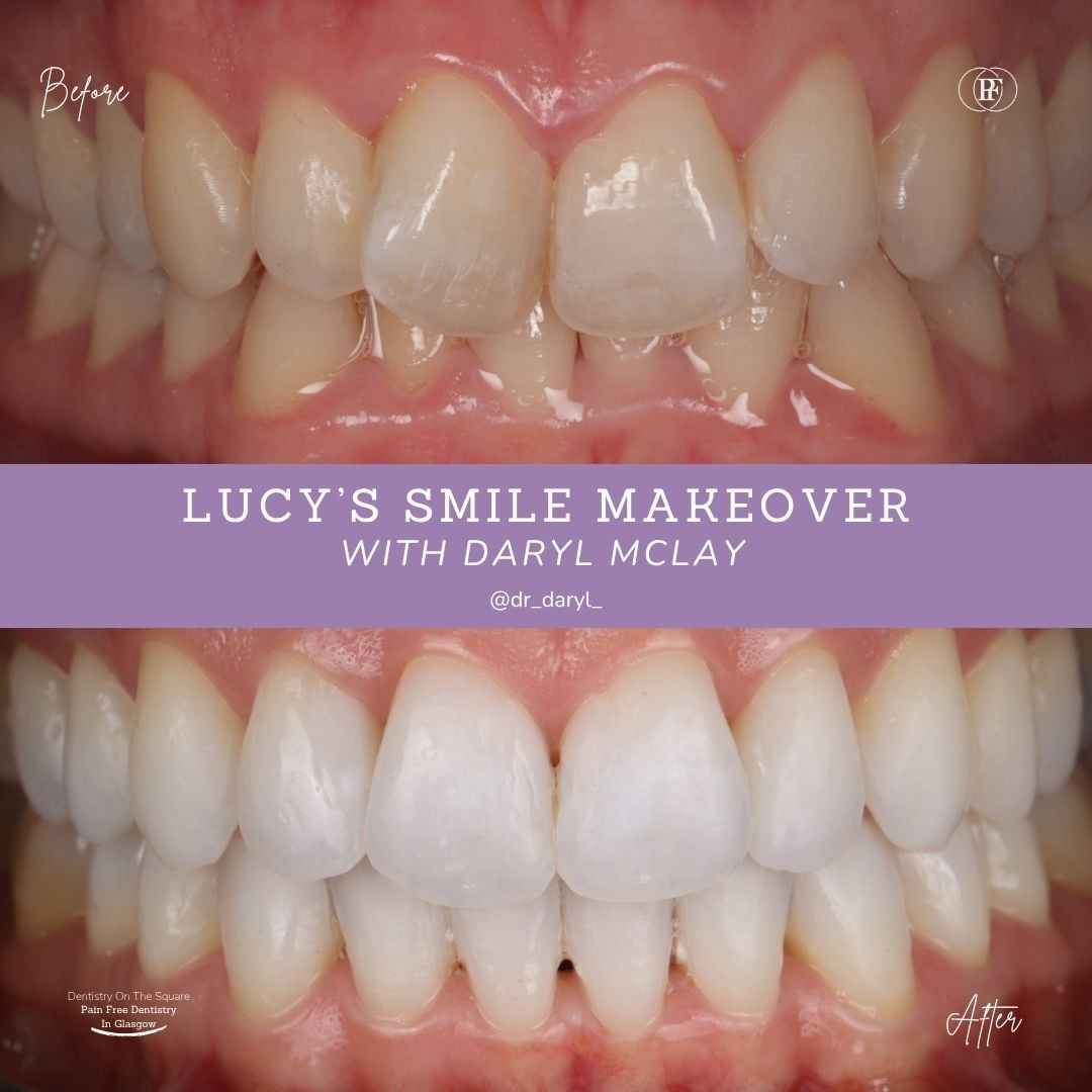 Dentistry On The Square, Pain Free Dentist Glasgow - Lucy's Smile Story Lucy S Smile Story With Daryl Mclay Posts