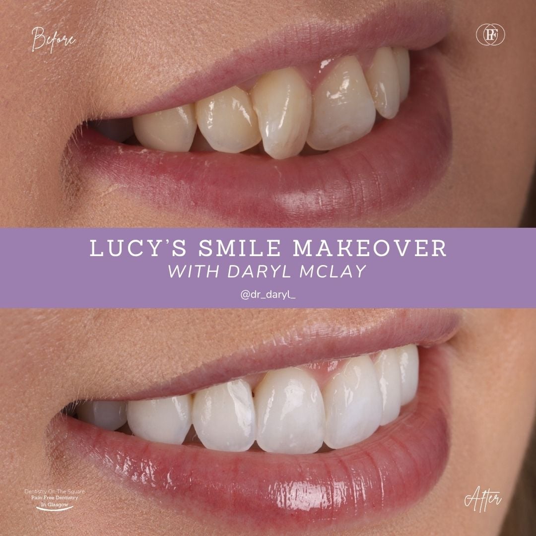 Dentistry On The Square, Pain Free Dentist Glasgow - Lucy's Smile Story Lucy S Smile Story With Daryl Mclay Posts