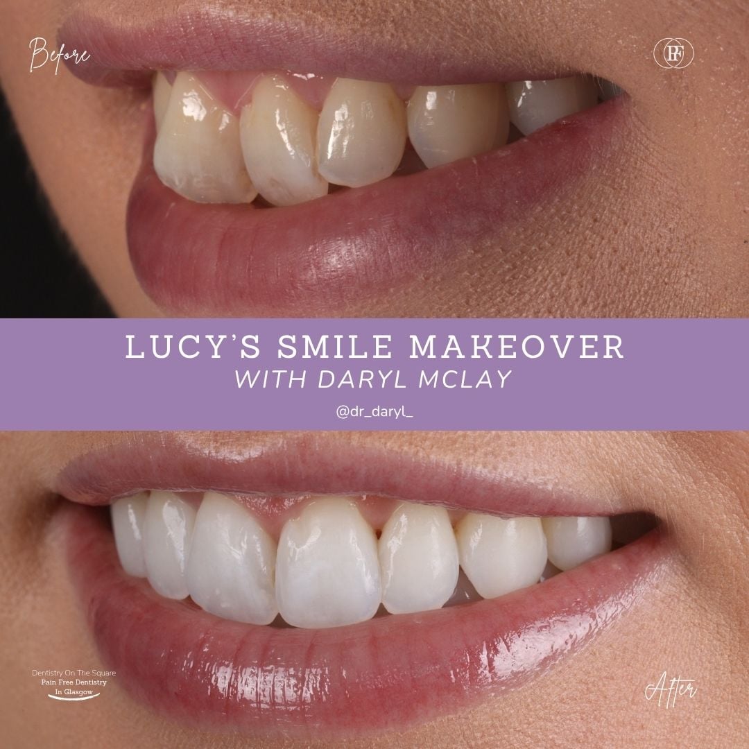 Dentistry On The Square, Pain Free Dentist Glasgow - Lucy's Smile Story Lucy S Smile Story With Daryl Mclay Posts