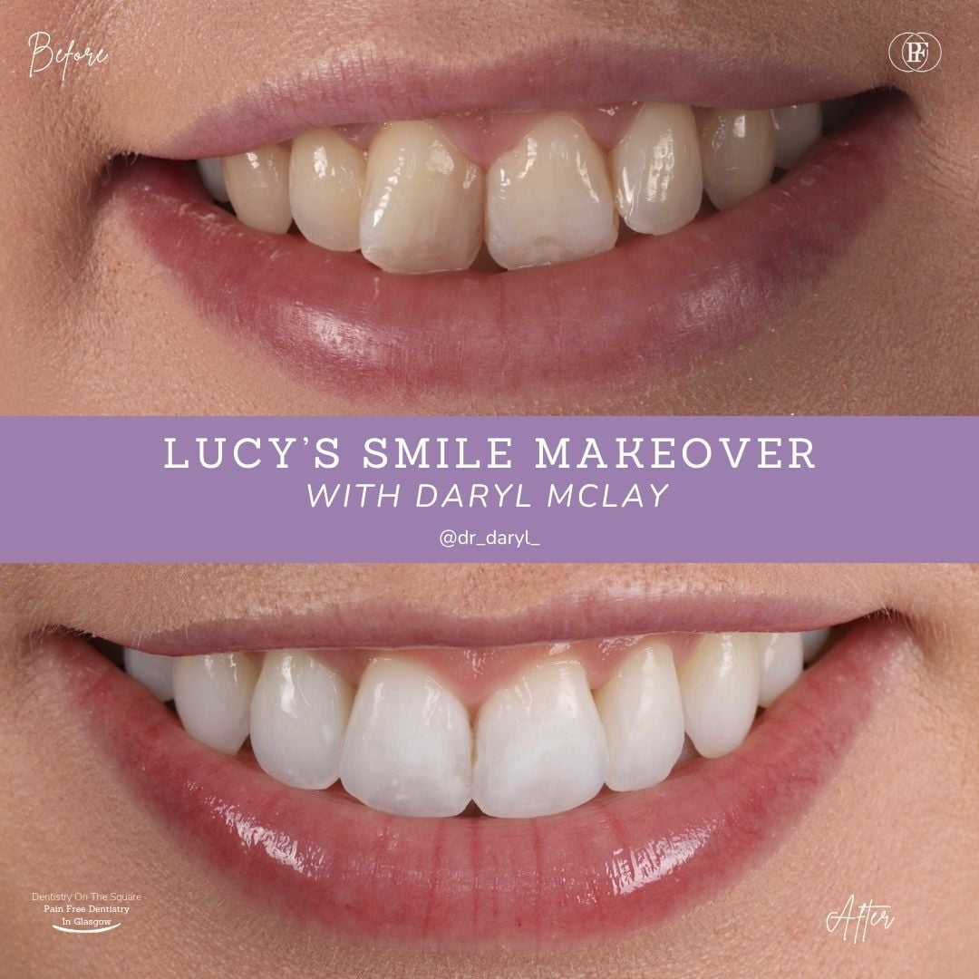 Dentistry On The Square, Pain Free Dentist Glasgow - Lucy's Smile Story Lucy S Smile Story With Daryl Mclay Posts