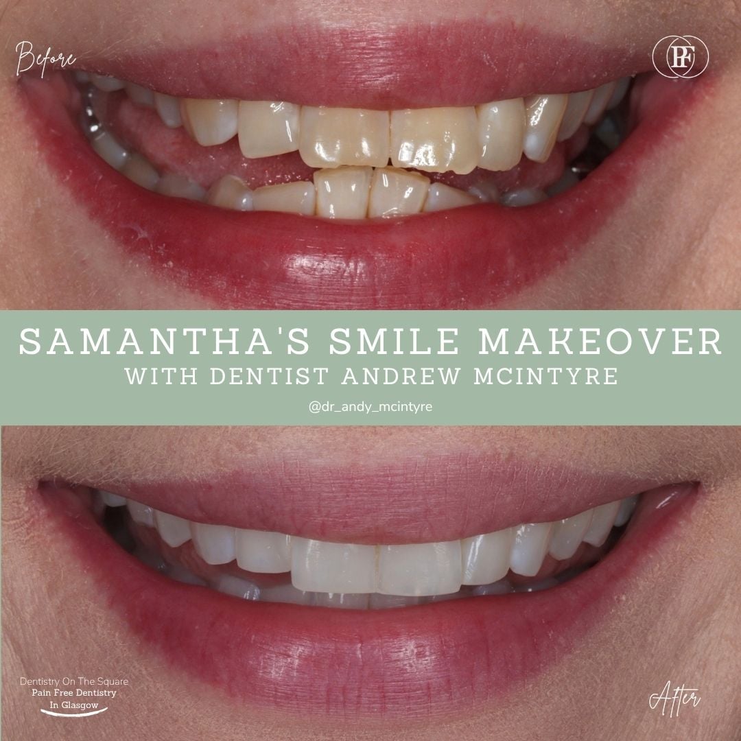 Dentistry On The Square, Pain Free Dentist Glasgow - Samantha's Smile Story Samantha S Smile Story With Andy Dots