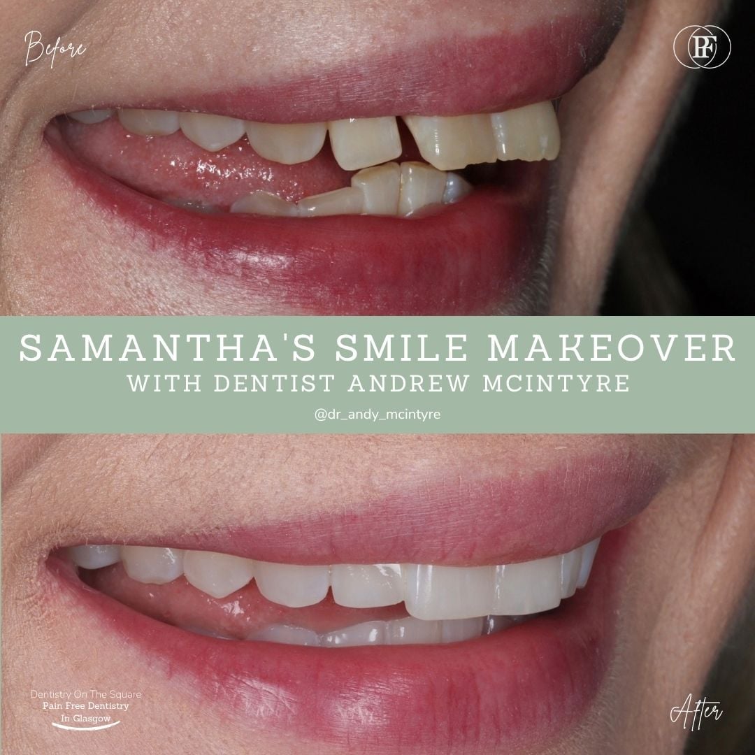Dentistry On The Square, Pain Free Dentist Glasgow - Samantha's Smile Story Samantha S Smile Story With Andy Dots