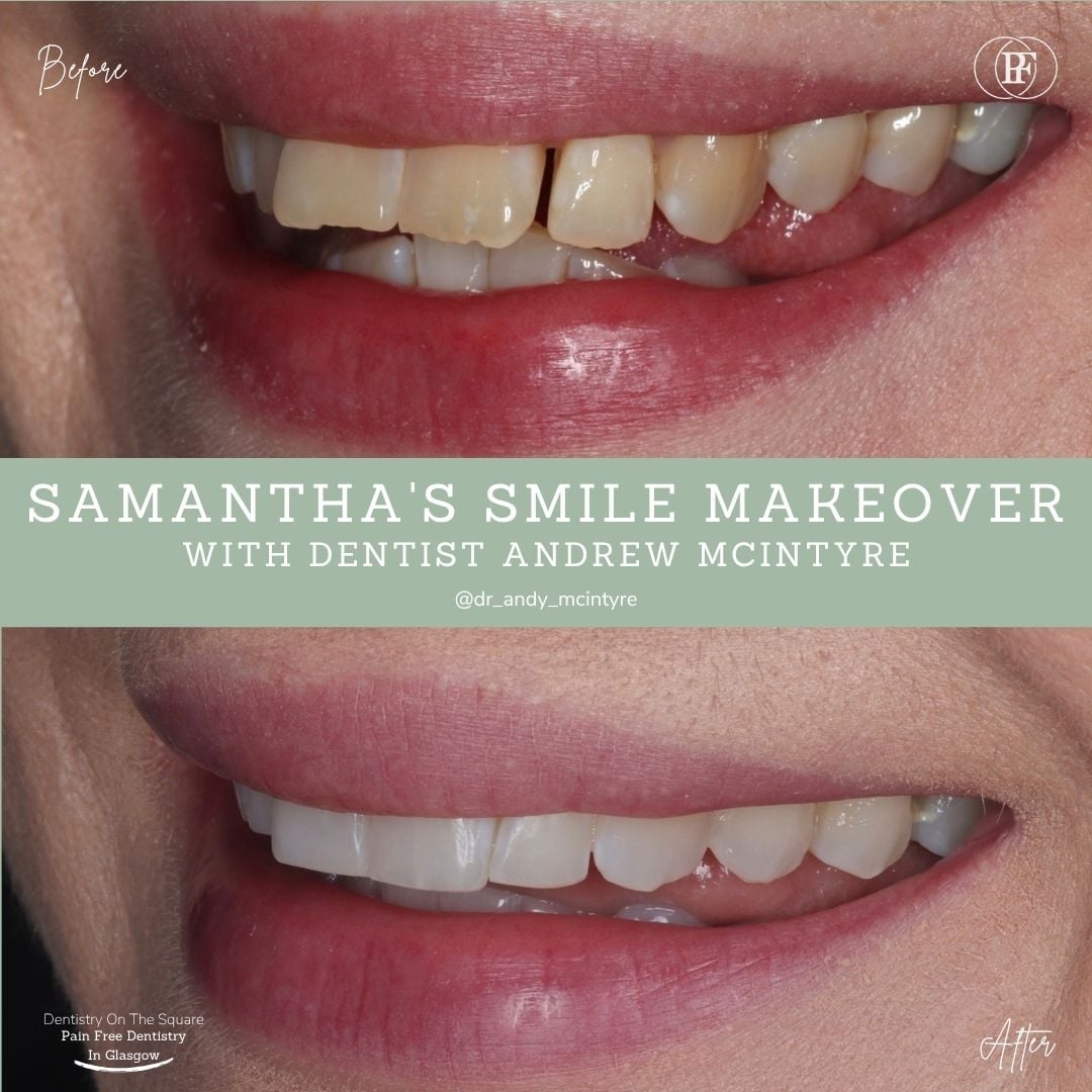 Dentistry On The Square, Pain Free Dentist Glasgow - Samantha's Smile Story Samantha S Smile Story With Andy Dots