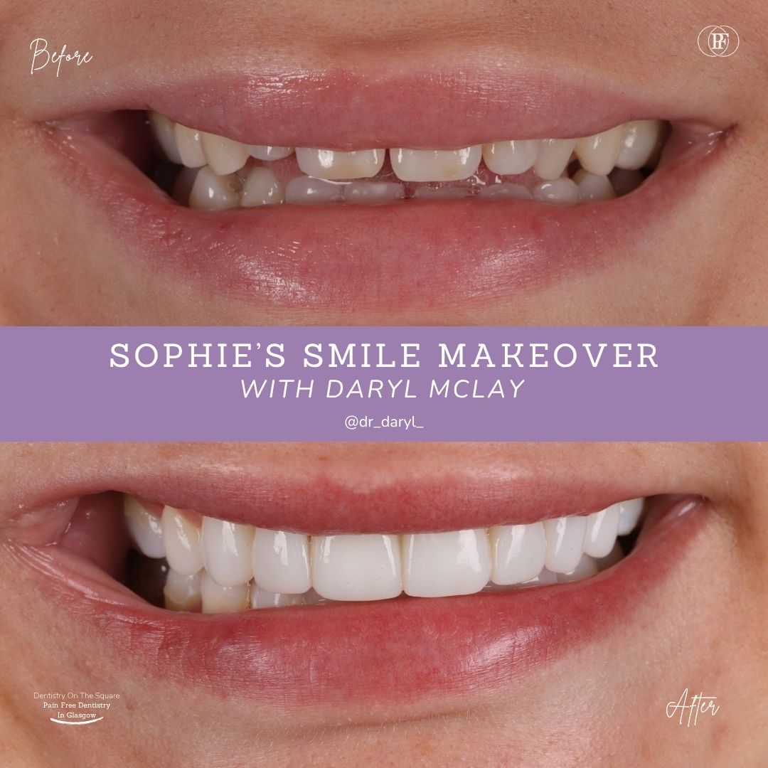 Dentistry On The Square, Pain Free Dentist Glasgow - Sophie's Smile Story Sophie S Smile Story With Daryl Mclay Posts