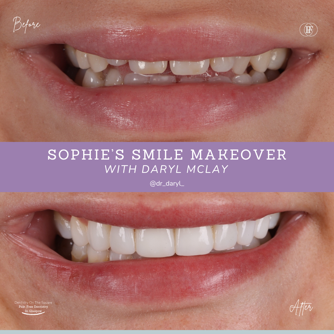 Dentistry On The Square, Pain Free Dentist Glasgow - Sophie's Smile Story Sophie S Smile Story With Daryl Mclay Posts