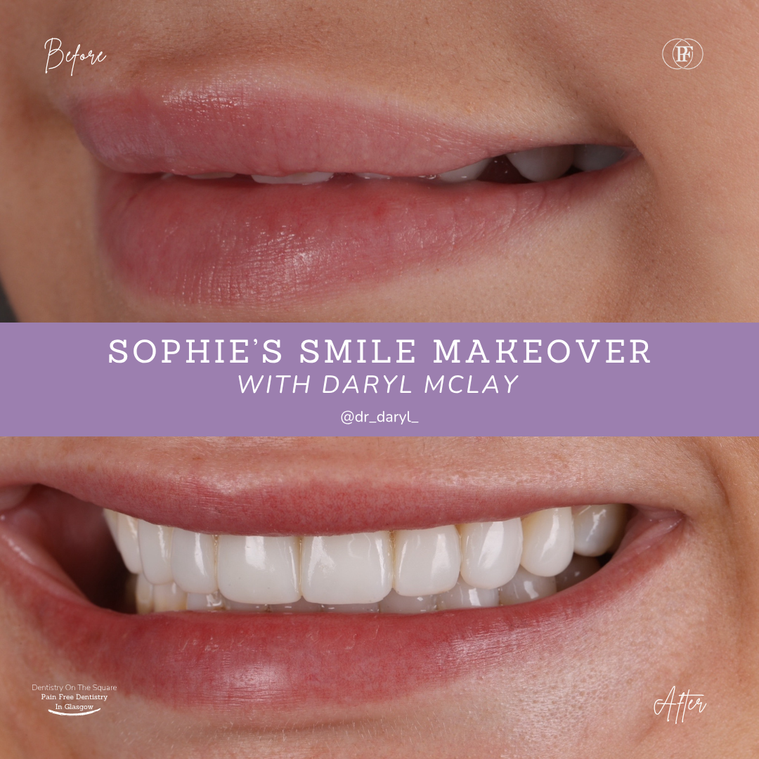 Dentistry On The Square, Pain Free Dentist Glasgow - Sophie's Smile Story Sophie S Smile Story With Daryl Mclay Posts