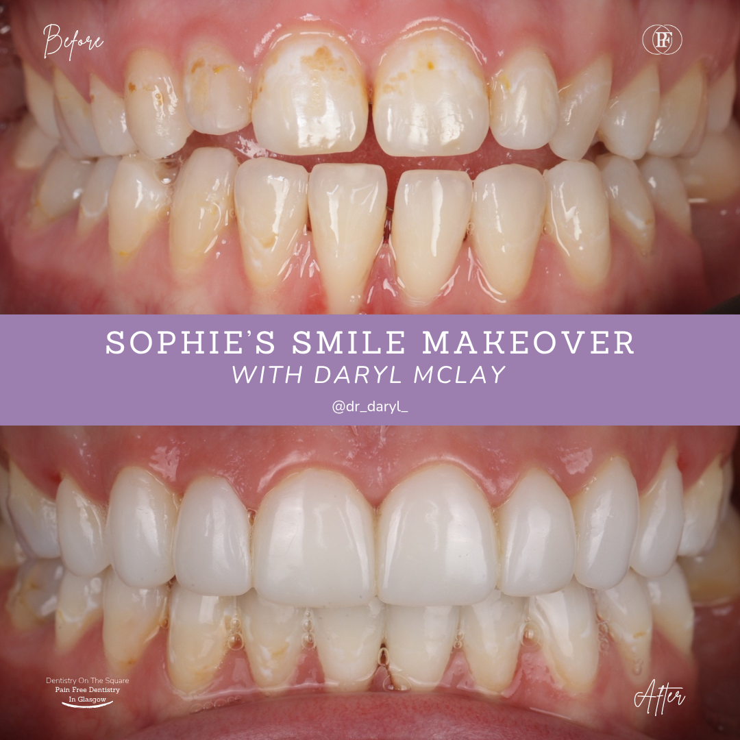 Dentistry On The Square, Pain Free Dentist Glasgow - Sophie's Smile Story Sophie S Smile Story With Daryl Mclay Posts