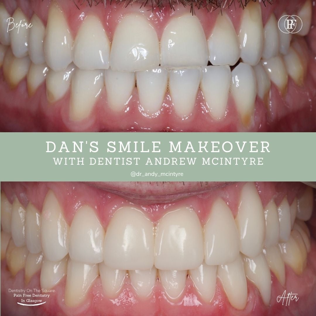 Dentistry On The Square, Pain Free Dentist Glasgow - Dan's Smile Story Dan S Smile Story With Andy Dots