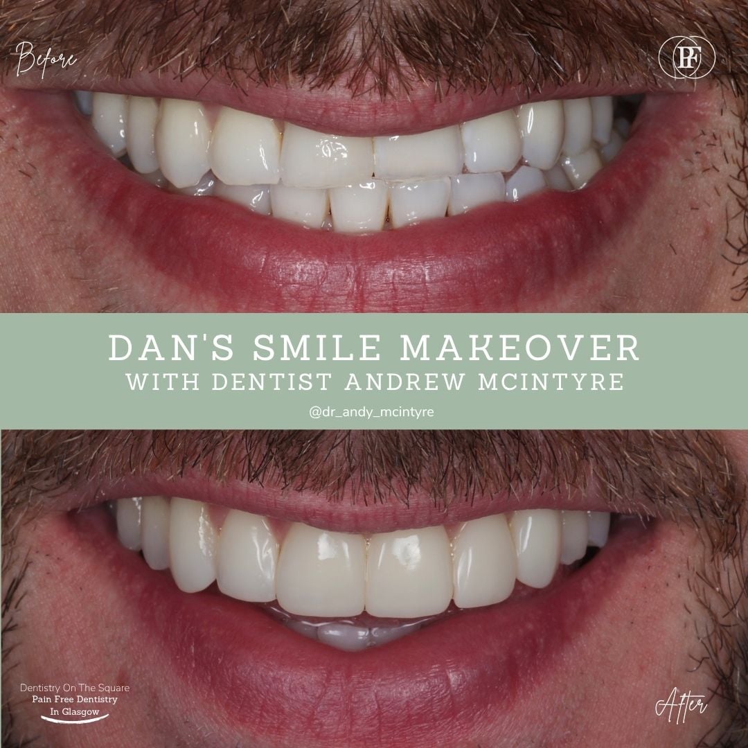 Dentistry On The Square, Pain Free Dentist Glasgow - Dan's Smile Story Dan S Smile Story With Andy Dots