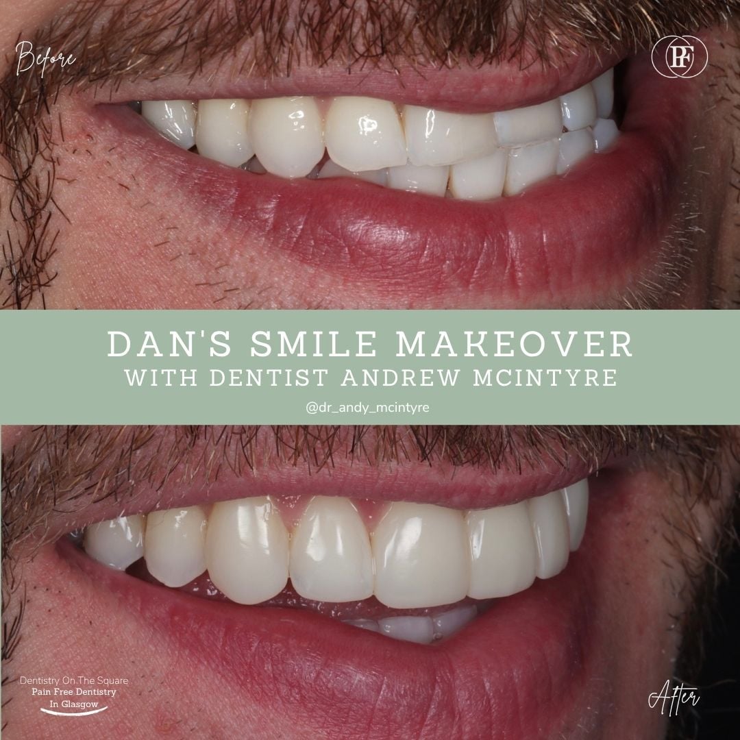 Dentistry On The Square, Pain Free Dentist Glasgow - Dan's Smile Story Dan S Smile Story With Andy Dots