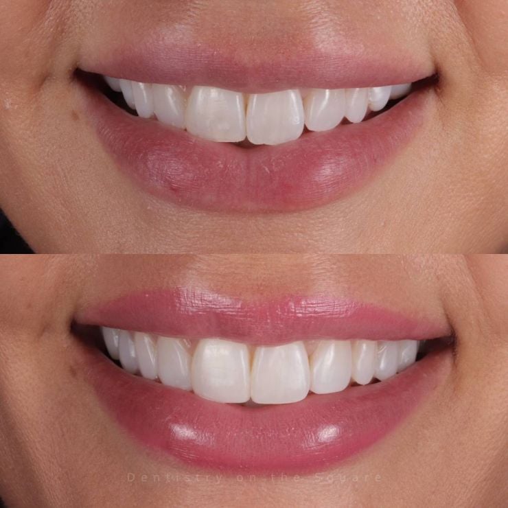 Transforming Smiles