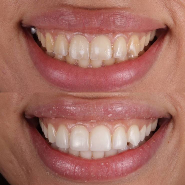 Transforming Smiles