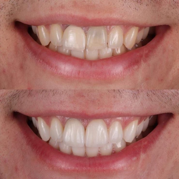 Dentistry On The Square, Pain Free Dentist Glasgow - Smile Gallery